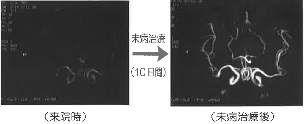 MRIによる脳血管の画像です。治療前と治療から10日後の比較写真